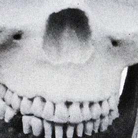 częściowo odtworzona czaszka Jadwigi von Andechs